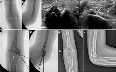 Comparison of ultrasound-guided closed reduction and percutaneous pinning fixation for unstable humeral lateral condylar fractures